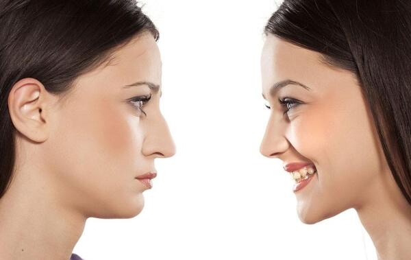 عکس بلافاصله بعد از عمل بینی نی نی سایت