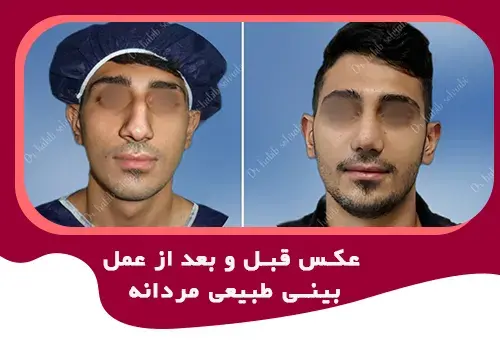 عکس بلافاصله بعد از عمل بینی نی نی سایت