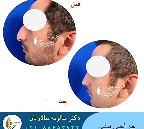 عکس بلافاصله بعد از عمل بینی نی نی سایت