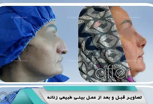 عکس بلافاصله بعد از عمل بینی نی نی سایت