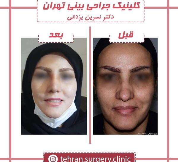 عکس بلافاصله بعد از عمل بینی نی نی سایت