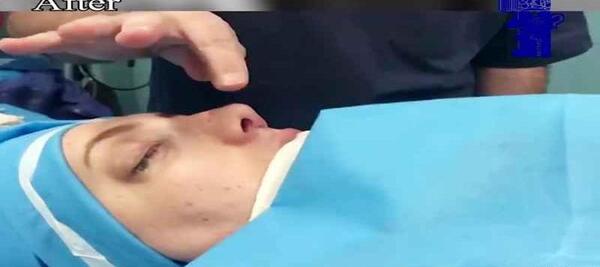 عکس بلافاصله بعد از عمل بینی نی نی سایت