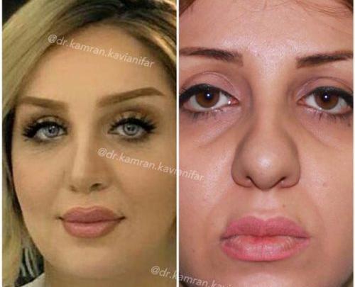 عکس بلافاصله بعد از عمل بینی نی نی سایت