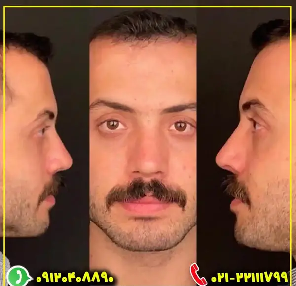 عکس بلافاصله بعد از عمل بینی نی نی سایت