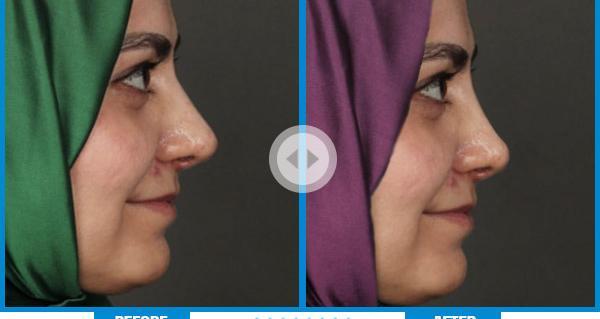 عکس قبل و بعد تزریق کورتون به بینی نی نی سایت