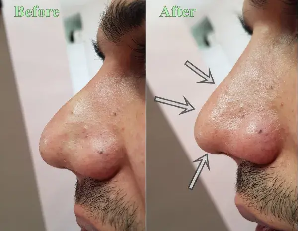 عکس قبل و بعد تزریق کورتون به بینی نی نی سایت
