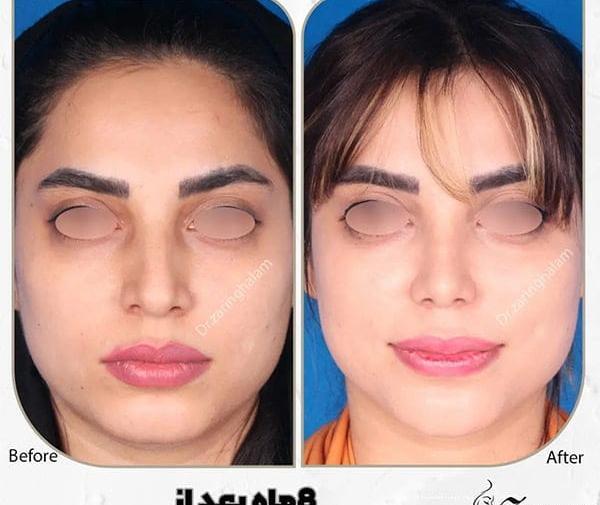 عکس قبل و بعد تزریق کورتون به بینی نی نی سایت