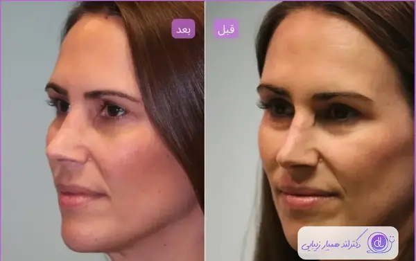 عکس قبل و بعد تزریق کورتون به بینی نی نی سایت