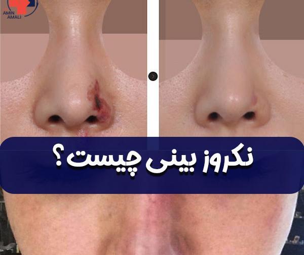 عکس قبل و بعد تزریق کورتون به بینی نی نی سایت