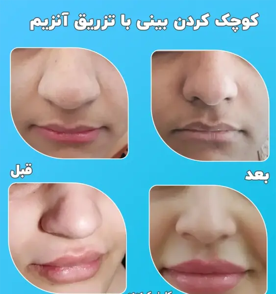 عکس قبل و بعد تزریق کورتون به بینی نی نی سایت