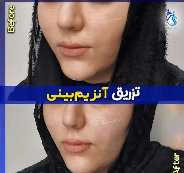عکس قبل و بعد تزریق کورتون به بینی نی نی سایت