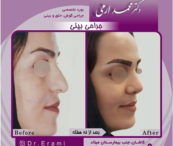 عکس قبل و بعد تزریق کورتون به بینی نی نی سایت