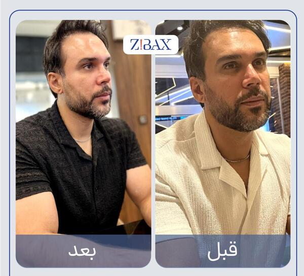 عکس قبل و بعد تزریق کورتون به بینی نی نی سایت