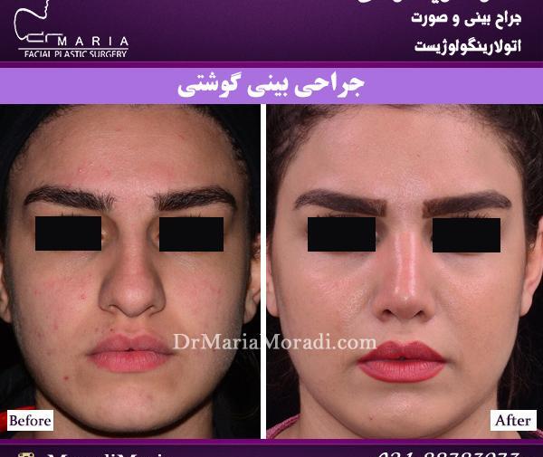 عکس قبل و بعد تزریق کورتون به بینی نی نی سایت