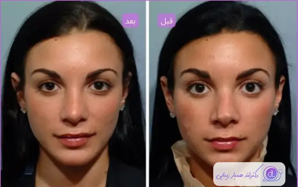 عکس قبل و بعد تزریق کورتون به بینی نی نی سایت