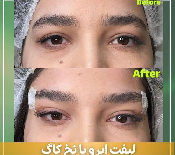 عکس لیفت ابرو نی نی سایت