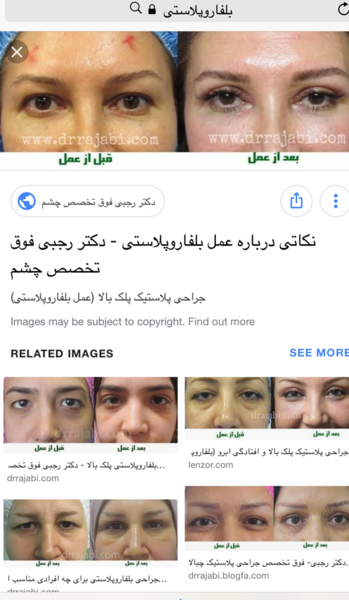 عکس لیفت ابرو نی نی سایت