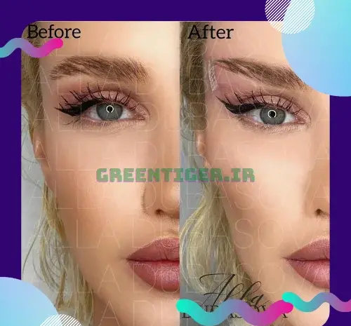 عکس لیفت ابرو نی نی سایت