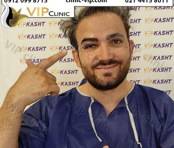 عکس لیفت ابرو نی نی سایت