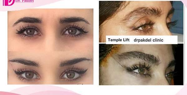 عکس لیفت ابرو نی نی سایت