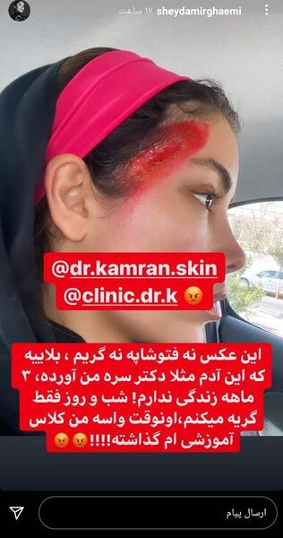 عکس لیفت ابرو نی نی سایت