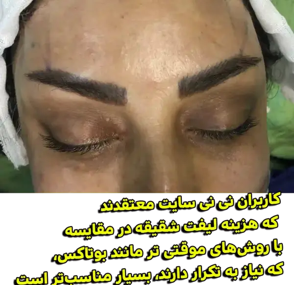عکس لیفت ابرو نی نی سایت