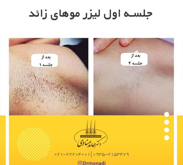 عکس های قبل و بعد لیزر موهای زائد