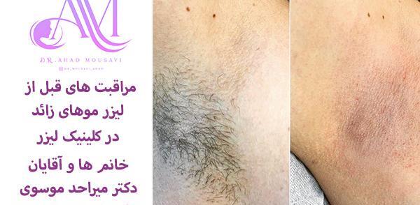 عکس های قبل و بعد لیزر موهای زائد