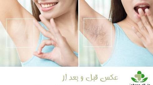 عکس های قبل و بعد لیزر موهای زائد