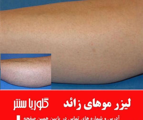 عکس های قبل و بعد لیزر موهای زائد