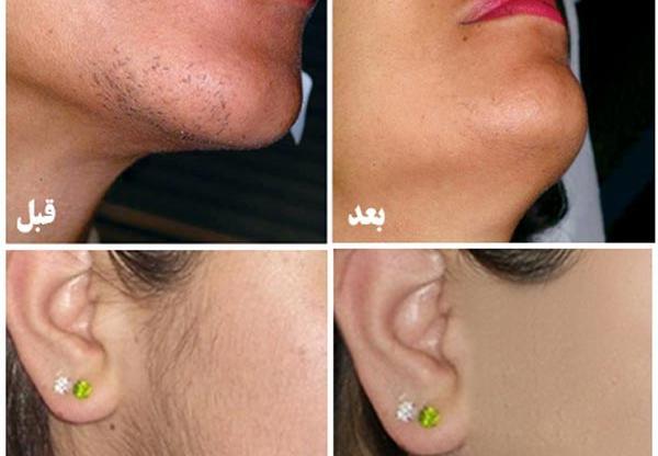 عکس تصویر لیزر موهای زائد بدن پرنیان مشهد