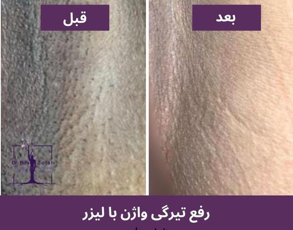 عکس لیزر موهای زائد ناحیه تناسلی زنان