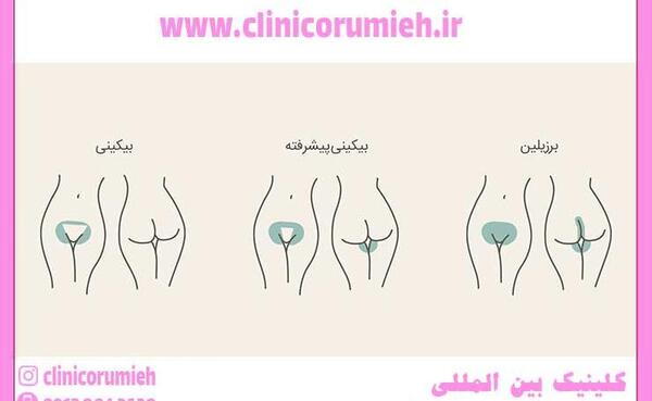 عکس لیزر موهای زائد ناحیه تناسلی
