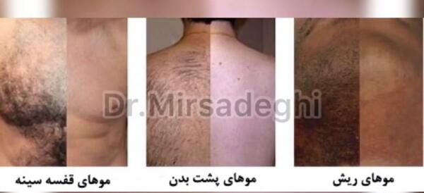 عکس لیزر موهای زائد ناحیه تناسلی