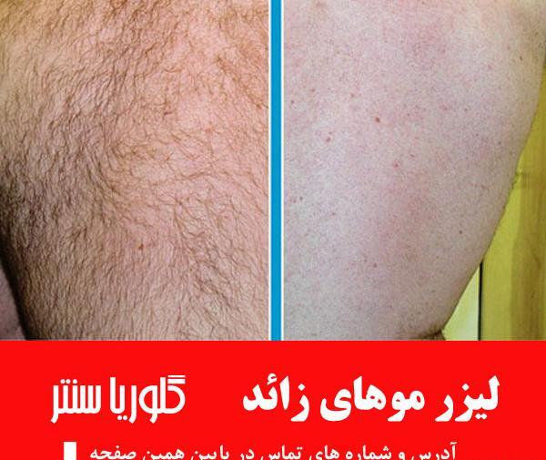 عکس لیزر موهای زائد ناحیه تناسلی