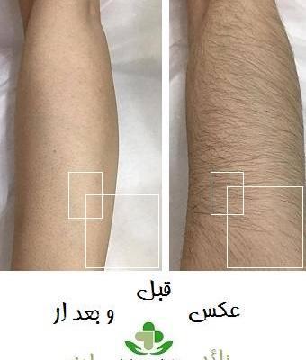 عکس قبل و بعد لیزر موی زائد