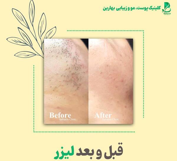عکس قبل و بعد لیزر موی زائد