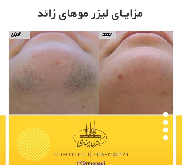 عکس قبل و بعد لیزر موی زائد