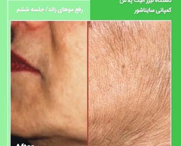 عکس قبل و بعد لیزر موی زائد