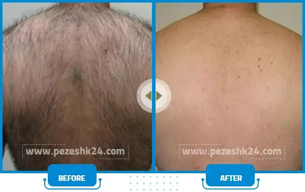 عکس قبل و بعد لیزر موی زائد