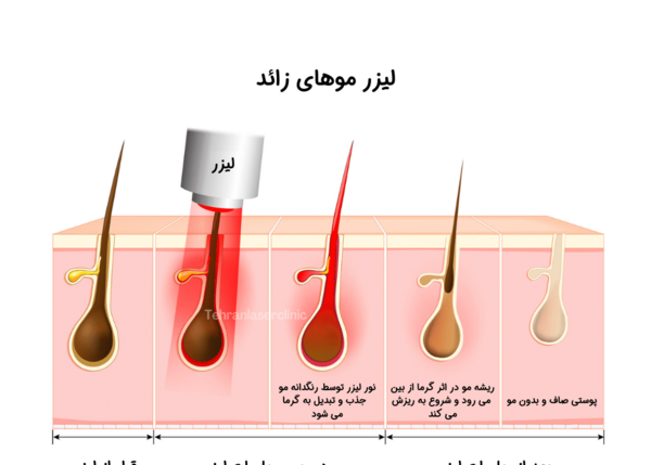 عکس قبل و بعد لیزر موی زائد