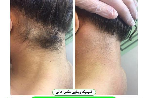 عکس قبل و بعد لیزر موی زائد