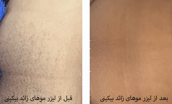 عکس لیزر موهای زائد بیکینی