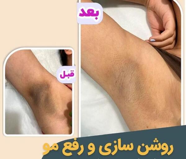 عکس لیزر موهای زائد بیکینی