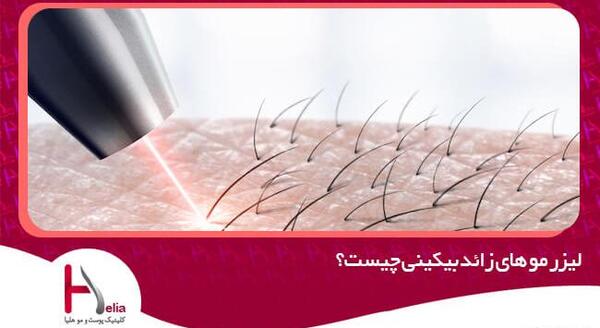 عکس لیزر موهای زائد بیکینی