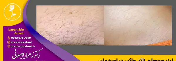 عکس لیزر موهای زائد بیکینی