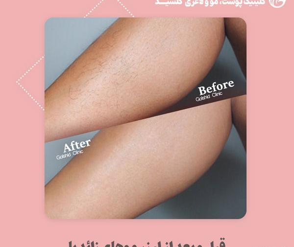 عکس لیزر موهای زائد بیکینی