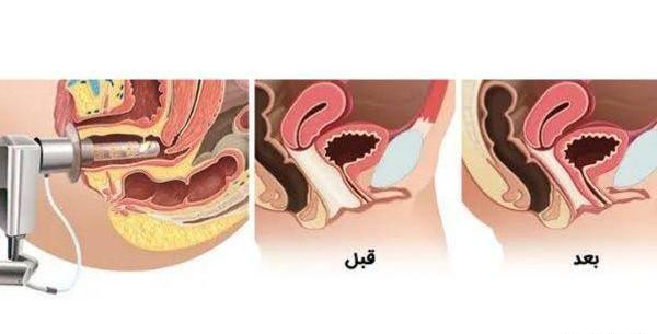 عکس لیزر مونالیزا
