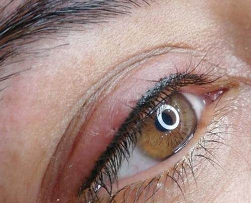 عکس پروفایل لیزر موهای زائد