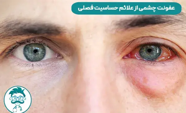عکس عفونت ویروسی چشم